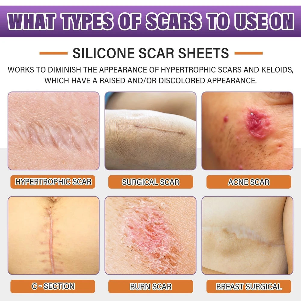Medical Grade Silicone Scar Sheets